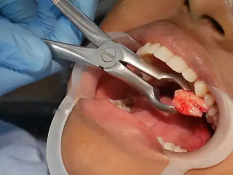 wisdom tooth surgery; Tips before surgery + steps, cost and quick recovery