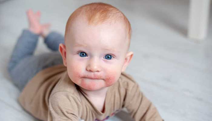 الأمراض الجلدية للأطفال وطرق علاجها - دكتور مهدي افشاري اخصائي حديثي الولادة والأطفال والمراهقين