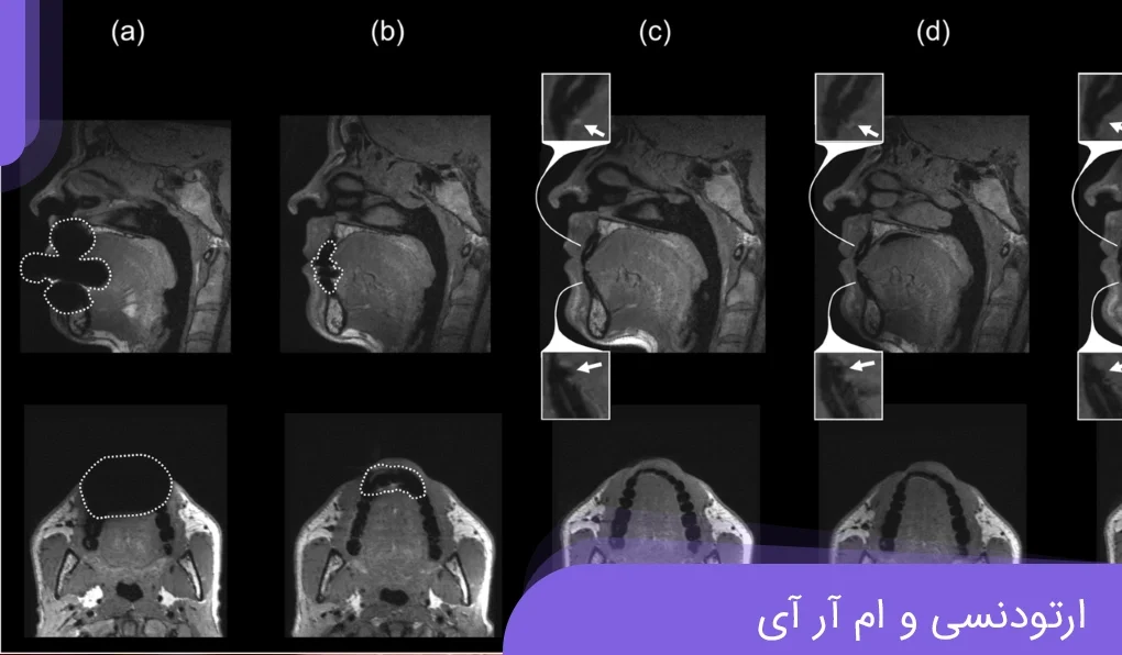 Is it dangerous to do MRI with metal orthodontics? Dr. Khadavi