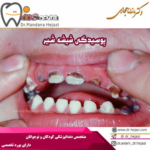 Removal of tooth decay caused by milk consumption in children by Dr. Mandana Hejazi in Tehran