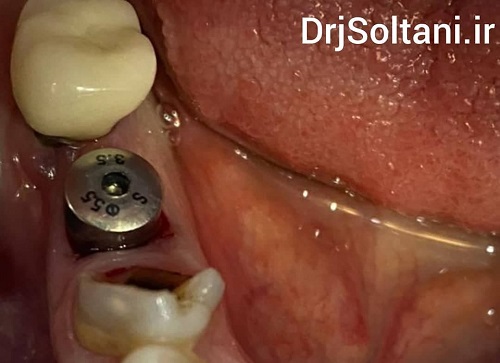 Implant portfolio Dr. Jamal Soltani, surgeon, dentist and implant specialist in Tabriz