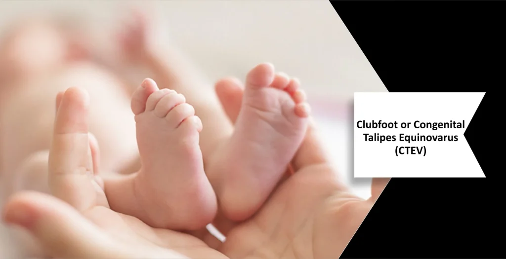 What is clubfoot?