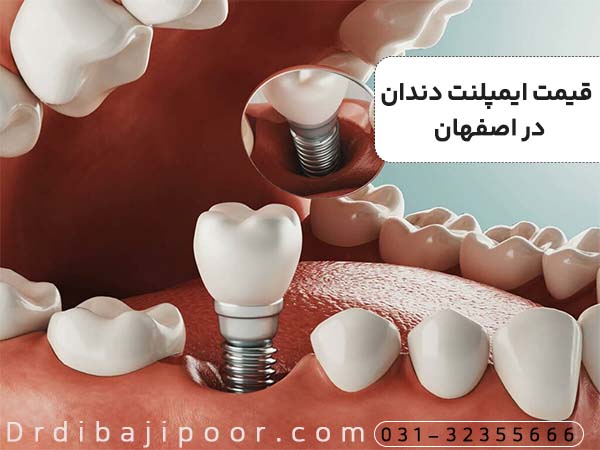 قیمت ایمپلنت دندان در اصفهان (به روز رسانی 1404). اقساط