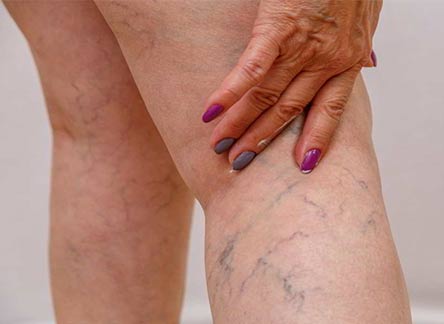 Complications of varicose veins - the dangers of neglecting the treatment of varicose veins | Iranian Superspeciality Center
