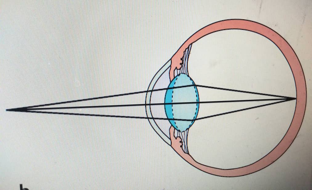 نقاط الضعف في العيون