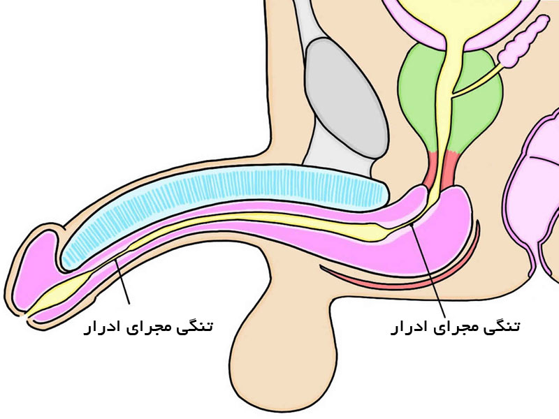Urethral stricture treatment method - Jahanshahr Urology Center