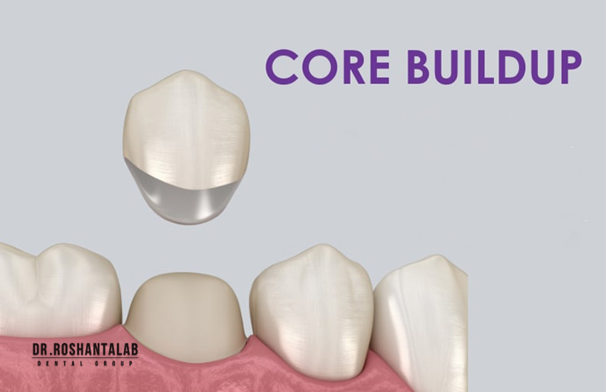 تراکم دندان چیست؟ مزایا و معایب دوام - مرکز تخصصی ایمپلنت دکتر روشن طلاب