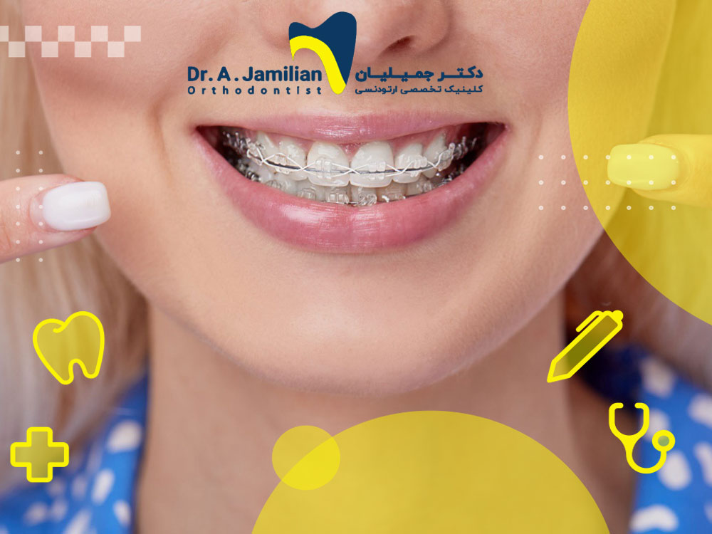 How to care for ceramic orthodontics to last longer - Dr. Jamilian