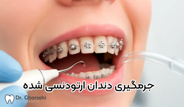جرم گیری دندان در حین ارتودنسی معرفی بهترین روش ها