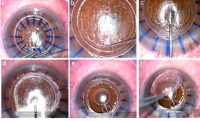 روشی نوین در جراحی چشم - دکتر مهرداد محمدپور