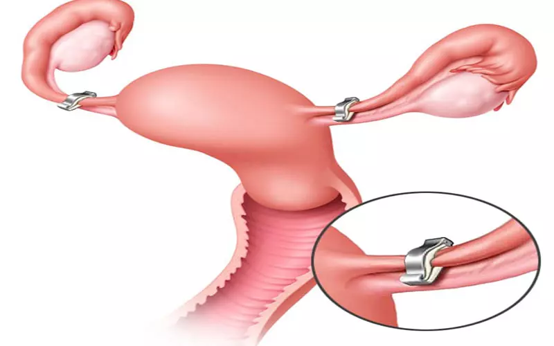 Stages of vasectomy and its recovery period - Jahanshahr Urology Center