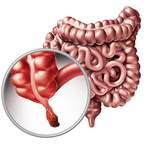 Appendix surgery center in Zafar