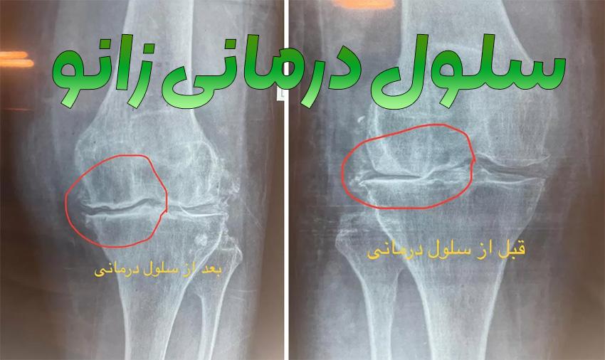 knee cell therapy | comprehensive guide, advantages, disadvantages, cost (year 1404)