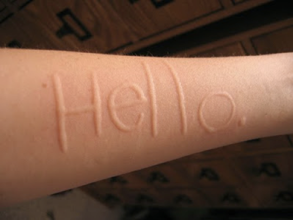 Physical urticaria - Dr. Jafari