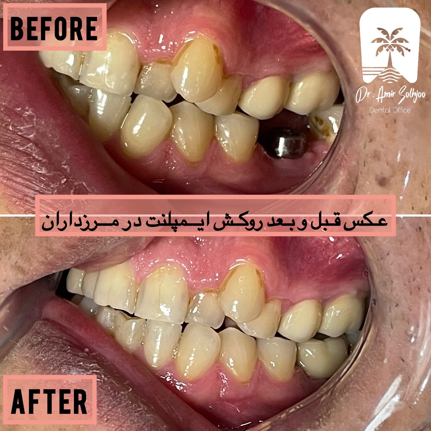 بهترین متخصص ایمپلنت در ایران: راهنمای انتخاب متخصص ایمپلنت دندان