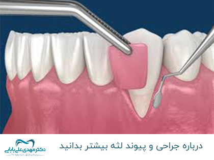 ما هو تطعيم اللثة - كل ما يتعلق بتطعيم اللثة + فترة التعافي