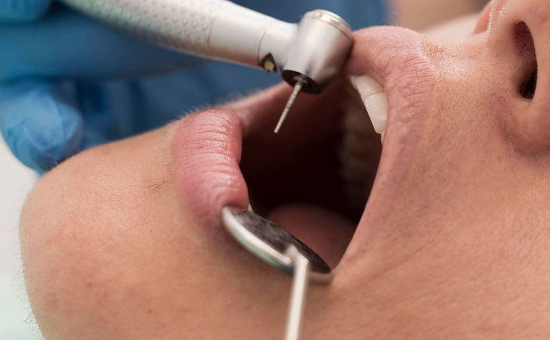 The cost of tooth filling 1404 + the exact tariff of filling types Amytis