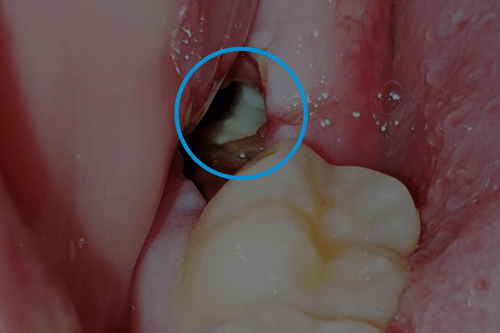 What is dry tooth cavity or dry silent? + Fast treatment Amytis