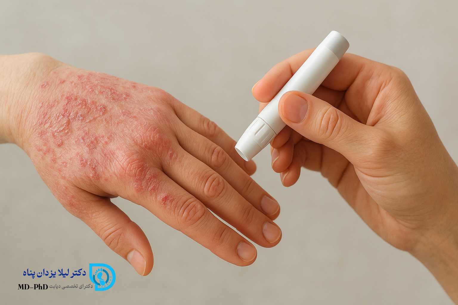 دیابت و پسوریازیس