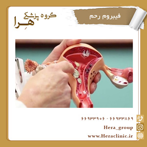 All about uterine fibroids