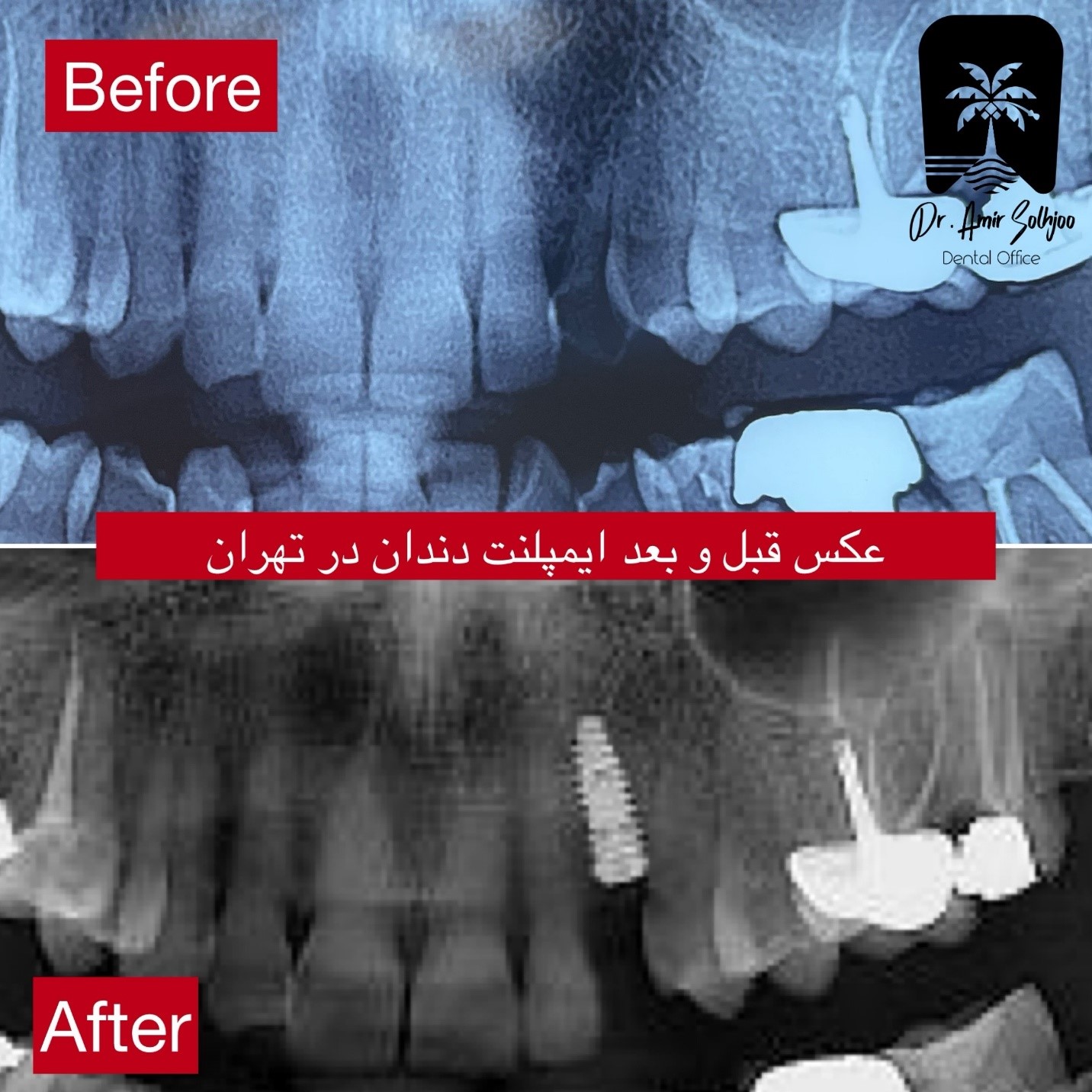 بهترین متخصص ایمپلنت در تهران: راهنمای انتخاب متخصص و شناخت بهترین برندها