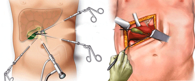 أفضل جراح المرارة في شمال طهران