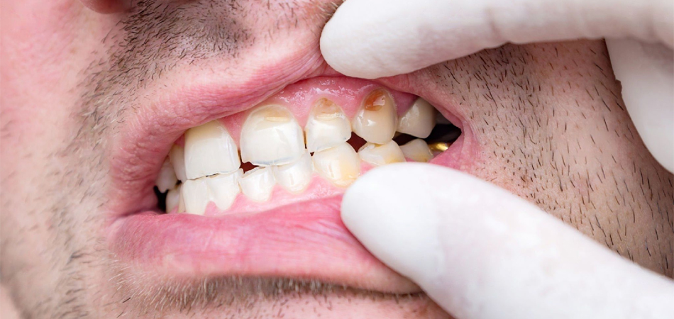Does composite cause tooth decay?