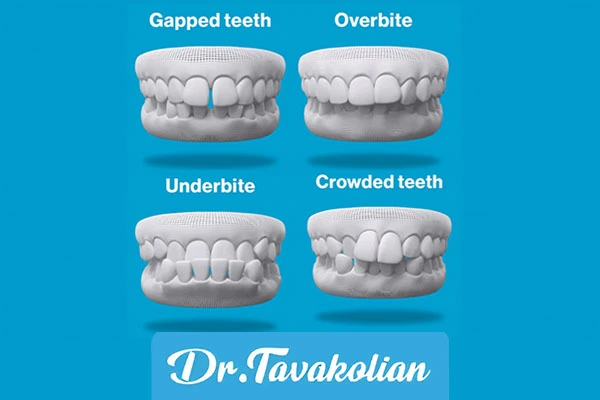پیشگیری از ناهنجاری های گاز گرفتگی در کودکان - دکتر توکلیان