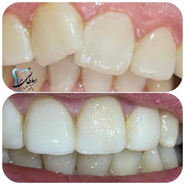اصلاح فرم چرخش دندان با کامپوزیت دکتر جمال سلطانی جراح دندانپزشک و متخصص ایمپلنت در تبریز