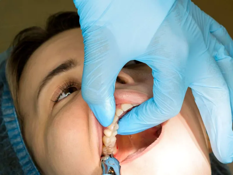 هل جراحة ضرس العقل مؤلمة؟ مراجعة الخبراء لتجربة الألم