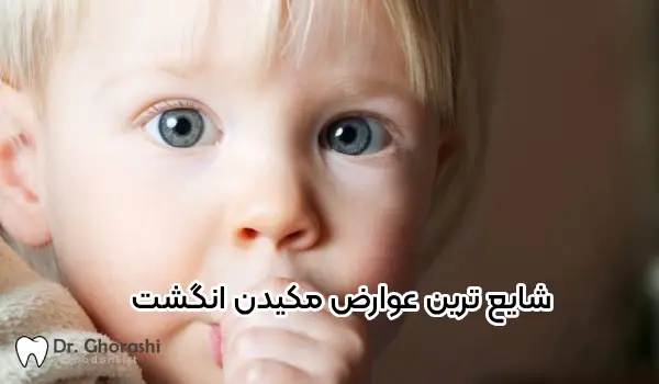 8 عارضه مکیدن انگشت در کودکان راه های پیشگیری و درمان