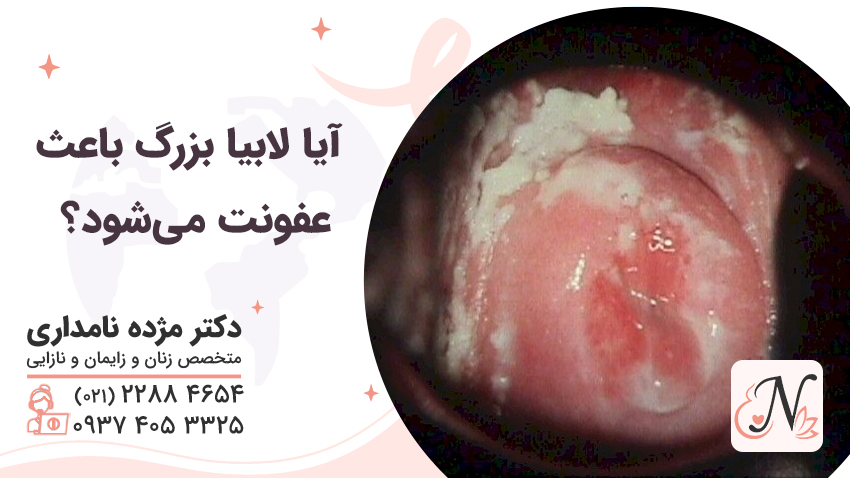 Does large labia cause infection? [Dr. Namdari's answer]