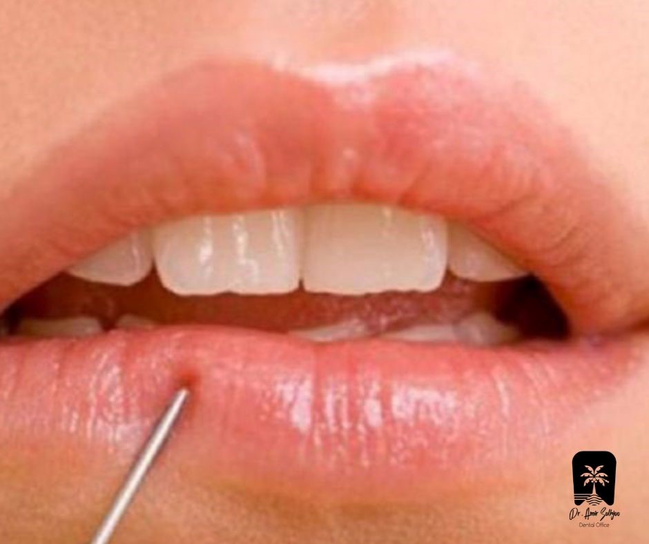 بی حسی لب پس از کاشت: علل، مدت زمان و راه حل های تخصصی