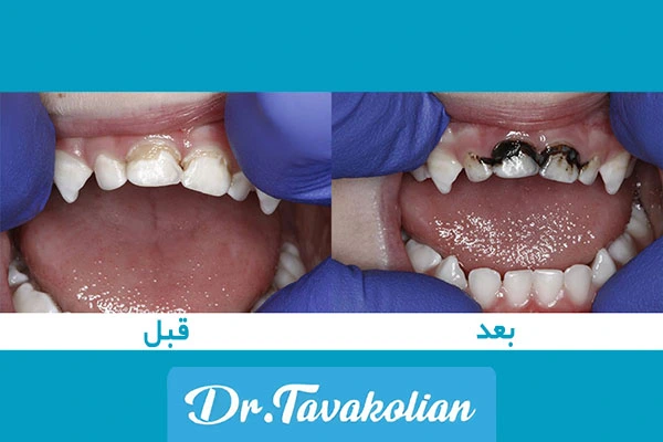 نقره درمانی دندان کودکان - دکتر توکلیان