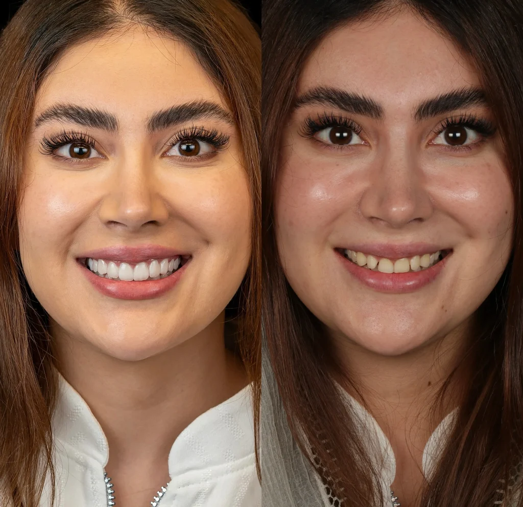 تفاوت کامپوزیت دندان و لمینت مقایسه جامع + هزینه در تهران