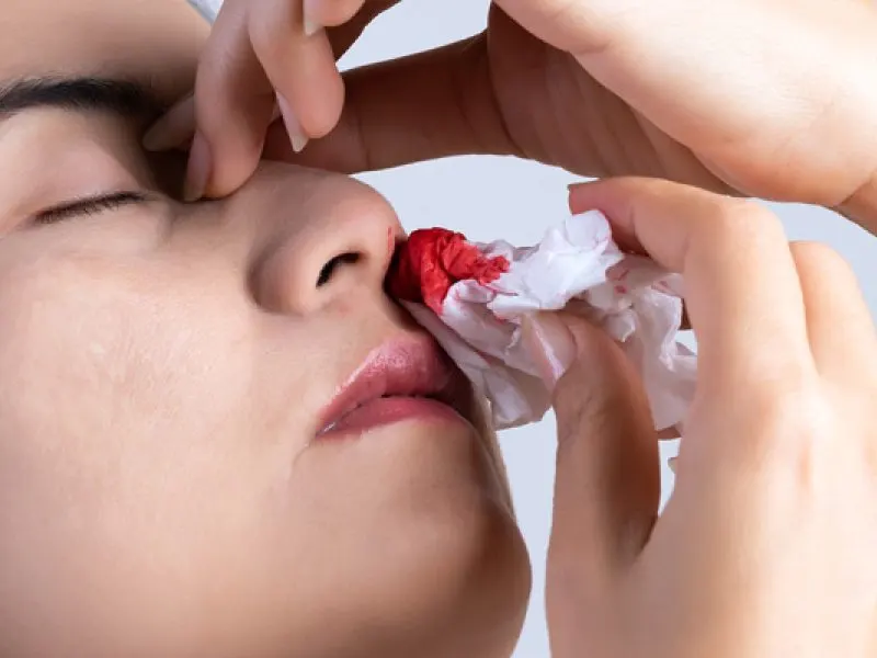 Bleeding after nose surgery + essential tips