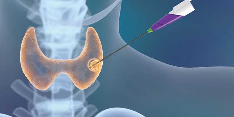 فرکانس رادیویی تیروئید چیست؟ چه زمانی توصیه نمی شود؟
