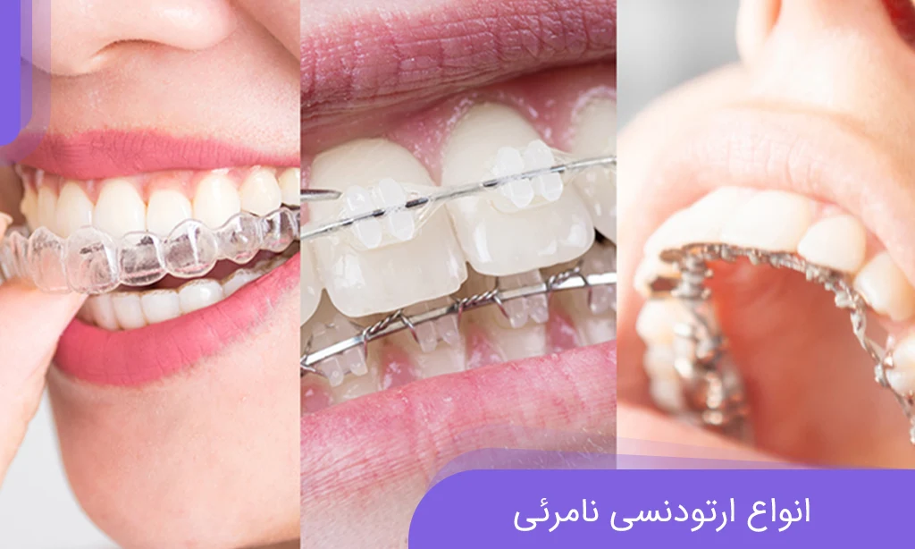 types of invisible orthodontics; Tips for better decision-making | Dr. Khadavi