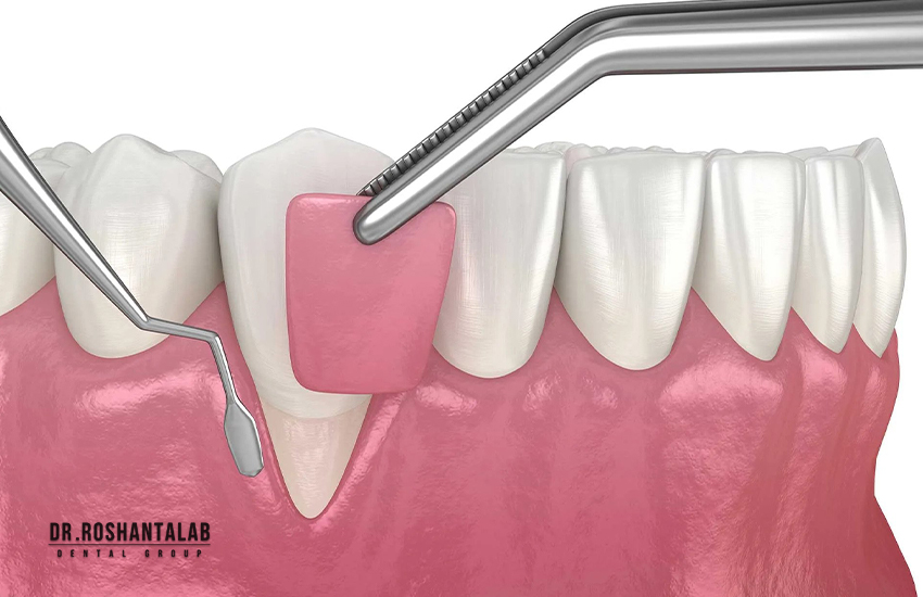 آیا جراحی لثه برای ایمپلنت انجام می شود؟ 5 دلیل مهم