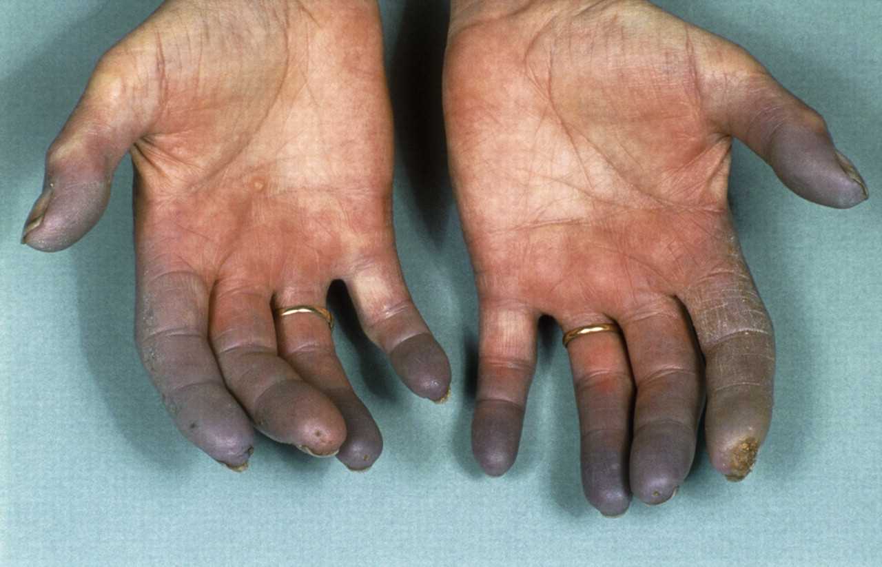 The cause of black hands and feet - Dr. Najafi