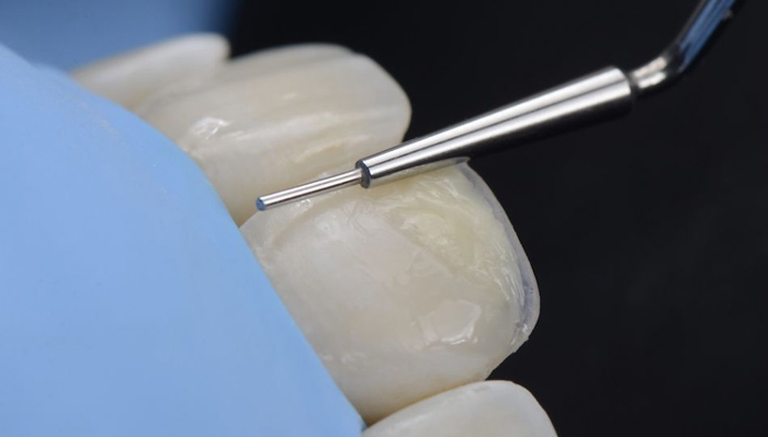 How thick should the dental composite be? + Its effect on beauty