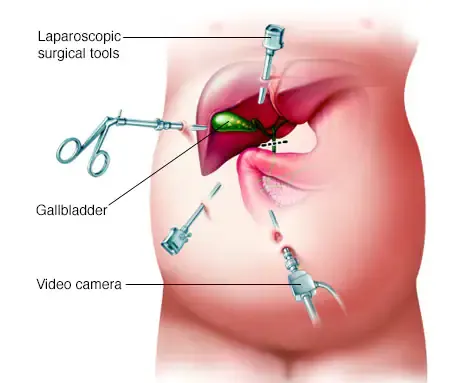 Gallbladder laparoscopy - gastroenterologist in Mashhad Dr. Mehdi Afzal Aghaei