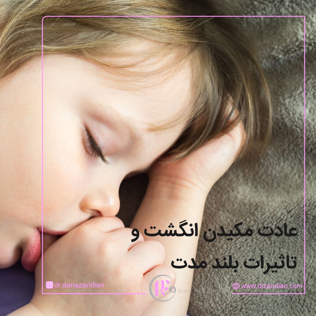 Finger-sucking habit and long-term effects - Dr. Dana Zandian - specialist in orthodontics and dental anomalies