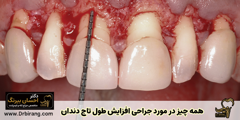Everything you need to know about dental crown lengthening surgery! - Dr. Ehsan Birang