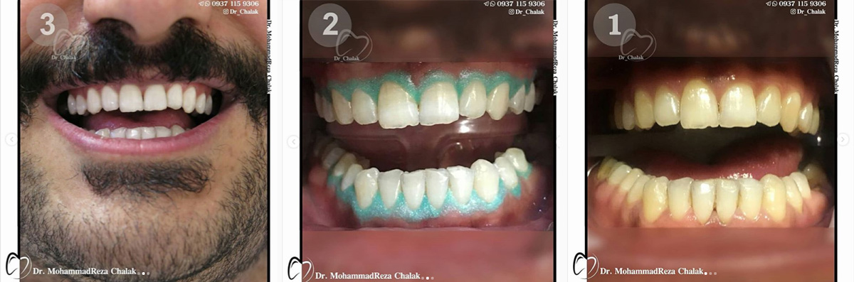 تبييض الأسنان في مشهد، مدة الصلاحية والتكلفة عام 1404