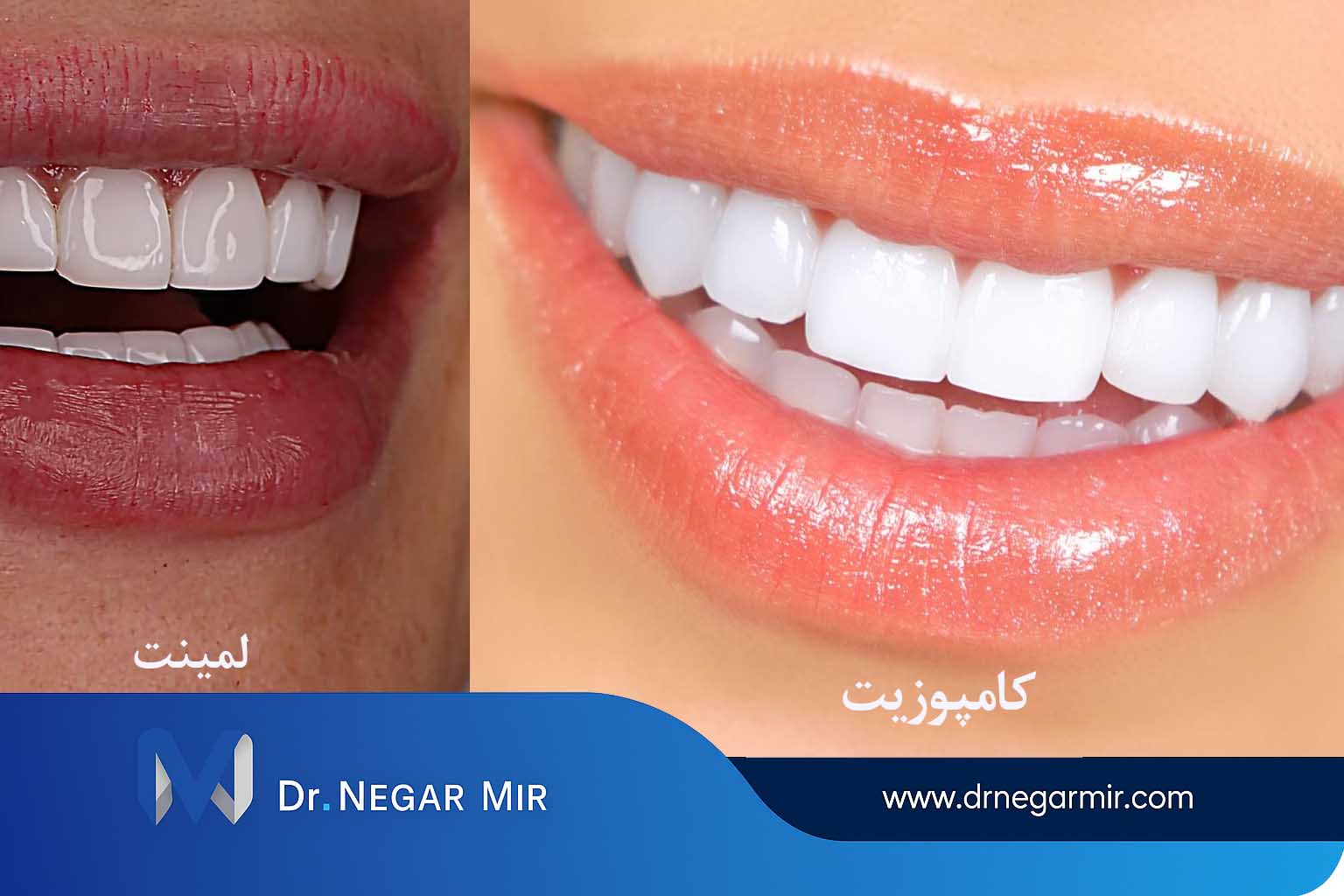 صفح أو مركب؟ ما هي الطريقة الأفضل لتصحيح تصميم الابتسامة؟ - طبيب الأسنان الدكتور نيجار مير