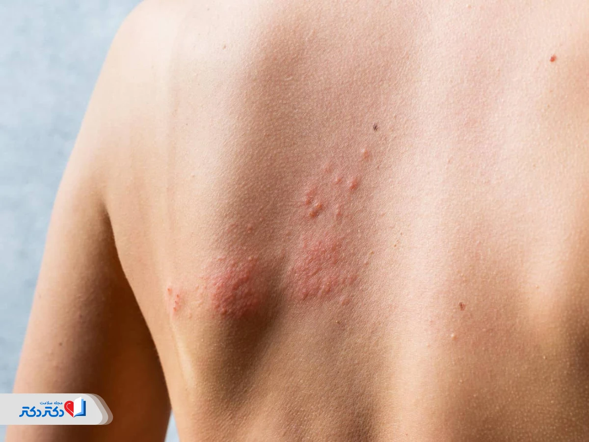 What is urticaria? Symptoms, causes and home remedies