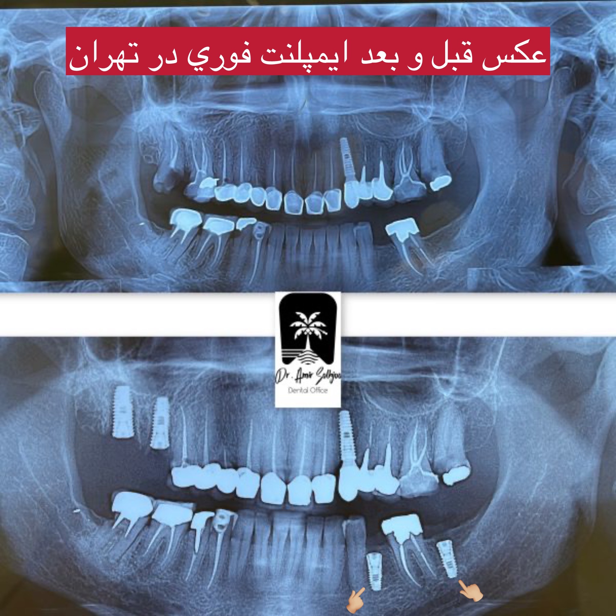 ایمپلنت در یک دقیقه کاشت فوری