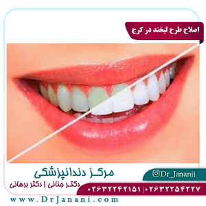 اصلاح طرح لبخند