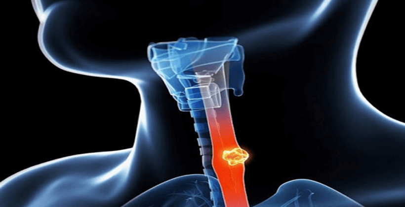 Everything about achalasia disease or esophageal disorder - gastroenterologist in Mashhad Dr. Mehdi Afzal Aghaei